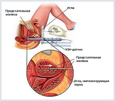 рака простаты