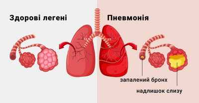 Интерстициальное заболевание легких - значительный фактор риска воспаления легких