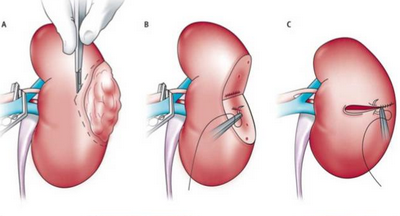 Криоабляция сравнима с хирургией при лечении рака почки на ранней стадии