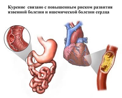 pylori