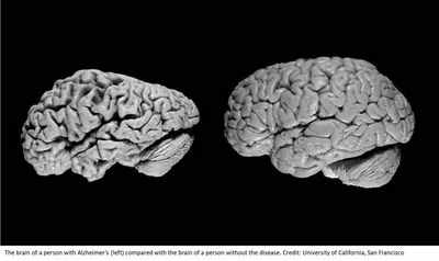 `` Птичьи мозги '' эффективны при болезни Альцгеймера