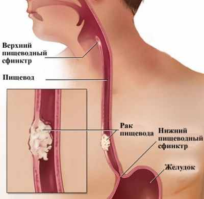 Изучение лучшей последовательности лечения рака пищевода