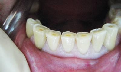 жёстких тканей