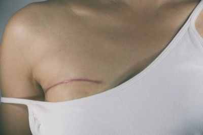 Устранение боли может стать проблемой после рака груди