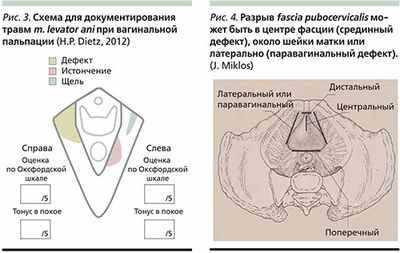 Вагинальные роды связаны с более поздним отсутствием поддержки тазовых органов